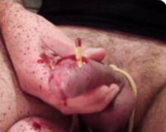A still image of my fucked up cock head bl33ding and with needles in it. the video got lost unfortunately because an older account here was reported and blocked